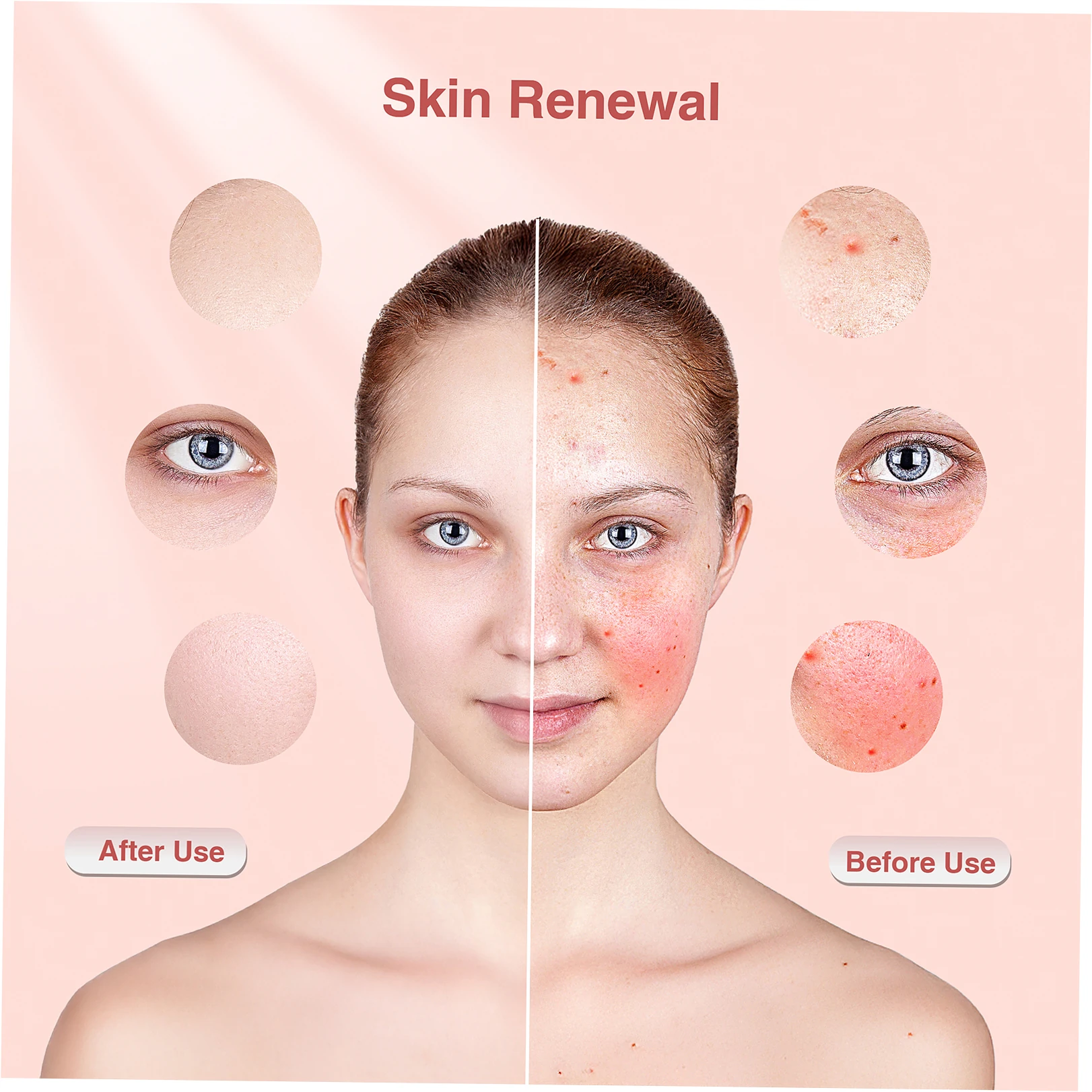 Acne Management and Inflammation Control